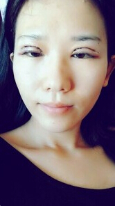 埋线双眼皮多久能恢复