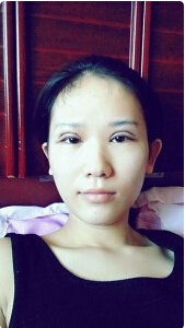 埋线双眼皮多久能恢复