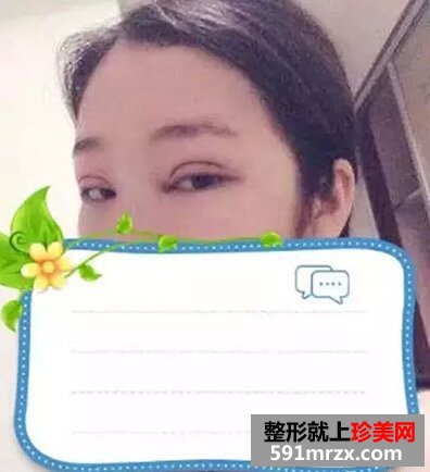 5s重睑术
