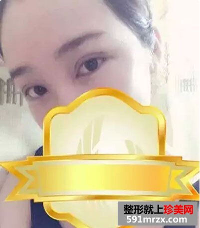 5s重睑术
