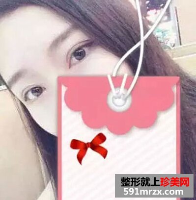 5s重睑术
