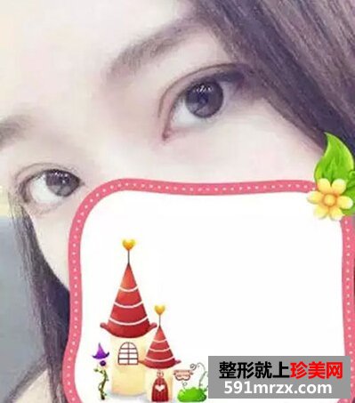 5s重睑术