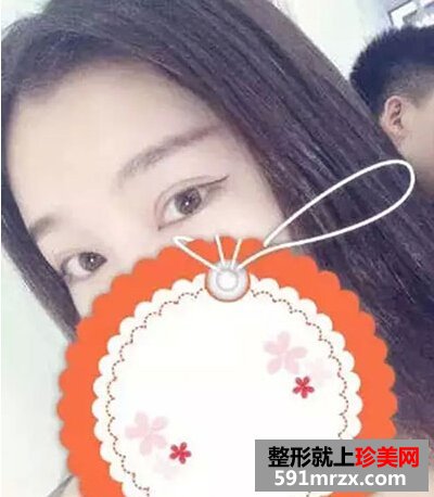 5s重睑术