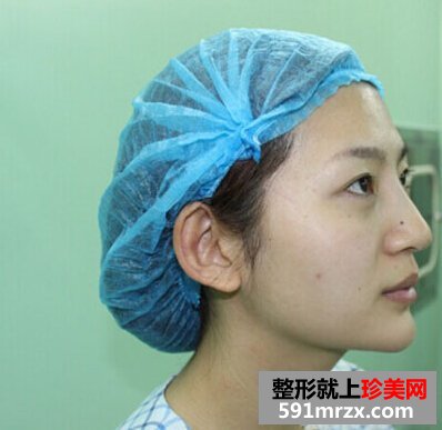 自体脂肪填充面部