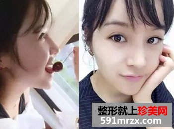 青州市人民医院,膨体假体隆鼻