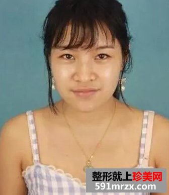 青州市人民医院,膨体假体隆鼻