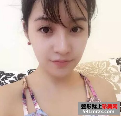 青州市人民医院,膨体假体隆鼻