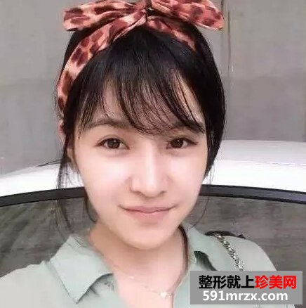 青州市人民医院,膨体假体隆鼻