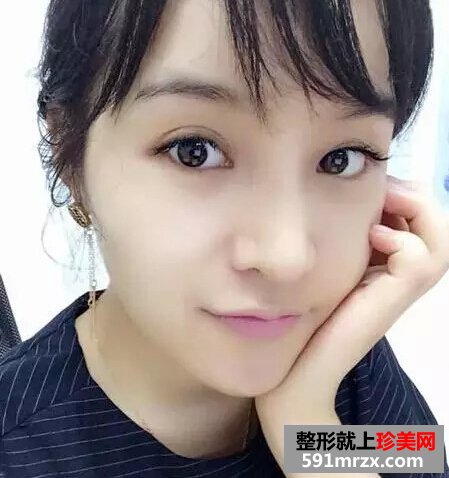 青州市人民医院,膨体假体隆鼻