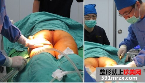 腿部吸脂手术多少钱
