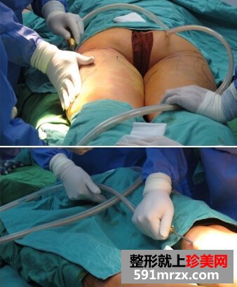 腿部吸脂手术多少钱