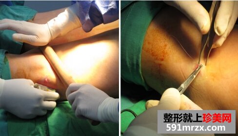 腿部吸脂手术多少钱