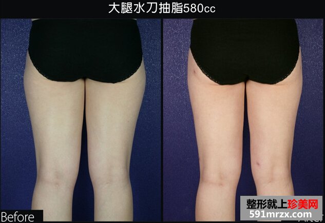 腿部吸脂手术多少钱