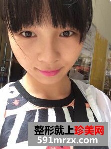 膨体隆鼻需要几天恢复