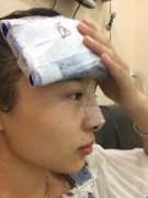 做完膨体隆鼻术后恢复很快