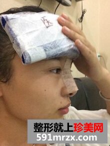膨体隆鼻需要几天恢复