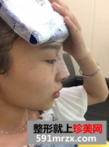 膨体隆鼻需要几天恢复