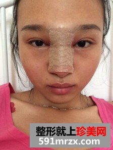 膨体隆鼻需要几天恢复