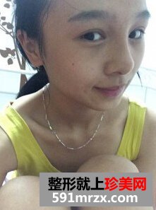 膨体隆鼻需要几天恢复