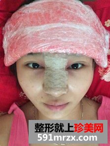 膨体隆鼻需要几天恢复