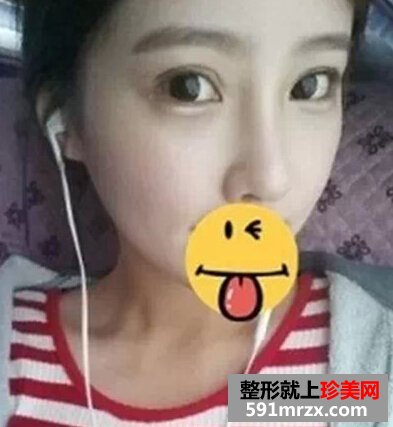 北京自体脂肪填充