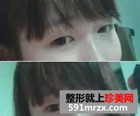 驼峰鼻矫正方法,惊艳人生