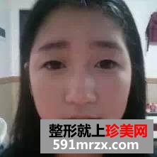 驼峰鼻矫正方法,惊艳人生