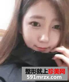 驼峰鼻矫正方法,惊艳人生