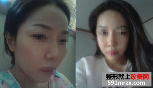 自体脂肪填充额头,咸鱼翻身是什么意思