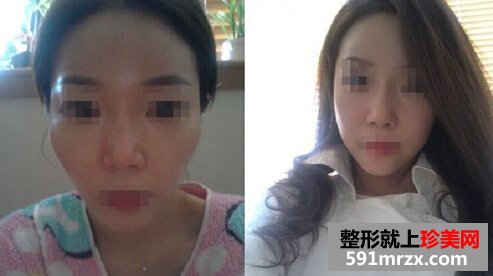 自体脂肪填充额头,咸鱼翻身是什么意思