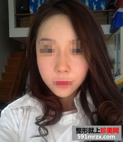 自体脂肪填充额头,咸鱼翻身是什么意思
