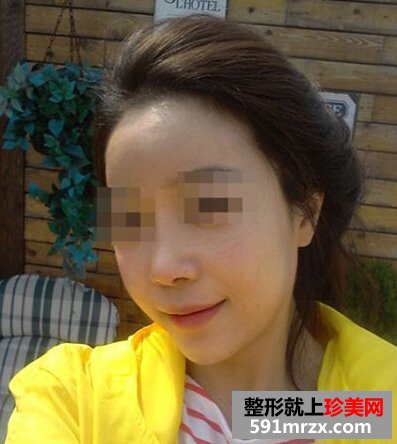 自体脂肪填充额头,咸鱼翻身是什么意思