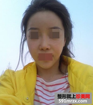 自体脂肪填充额头,咸鱼翻身是什么意思