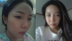 通过自体脂肪填充额头明白咸鱼翻身是什么意思