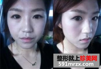 北京鼻部整形,自体脂肪移植丰脸,丑女大翻身