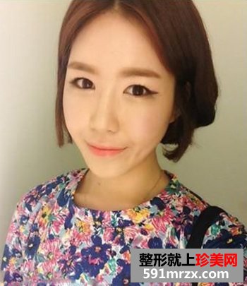 北京鼻部整形,自体脂肪移植丰脸,丑女大翻身