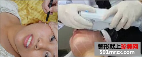 超声刀