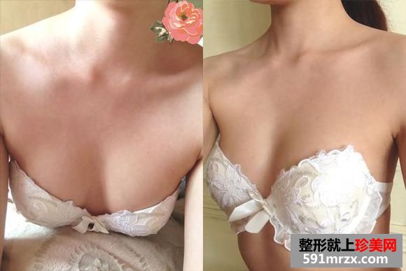 自体脂肪隆胸到京美,c罩杯美女