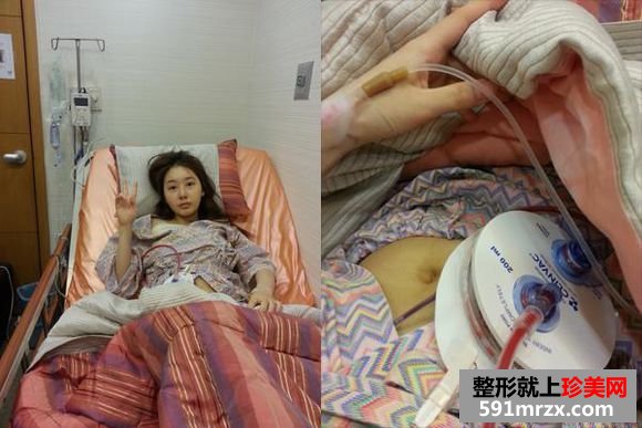 自体脂肪隆胸到京美,c罩杯美女