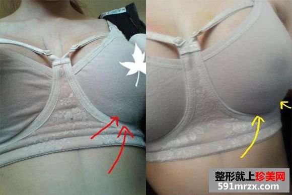 自体脂肪隆胸到京美,c罩杯美女