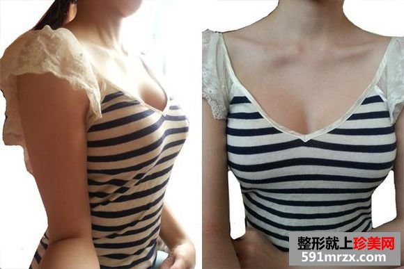 自体脂肪隆胸到京美,c罩杯美女