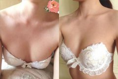 到京美做了自体脂肪隆胸变成c罩杯美女