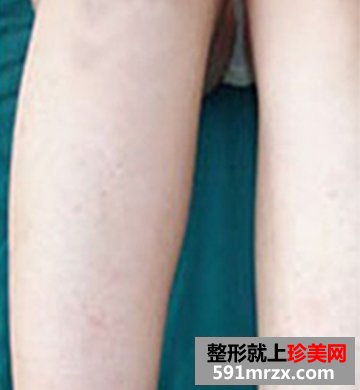 北京冰点脱毛医院,蓝宝石冰点脱毛