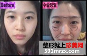 玻尿酸注射隆鼻术,韩式双眼皮前后对比