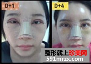 玻尿酸注射隆鼻术,韩式双眼皮前后对比