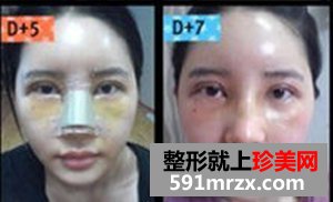 玻尿酸注射隆鼻术,韩式双眼皮前后对比
