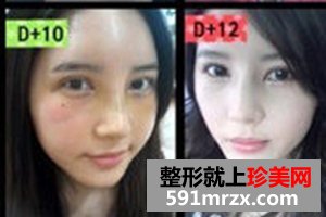 玻尿酸注射隆鼻术,韩式双眼皮前后对比