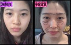 玻尿酸注射隆鼻术+韩式双眼皮前后对比让我苦尽甘来啊