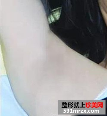 北京冰点脱毛医院,蓝宝石冰点脱毛