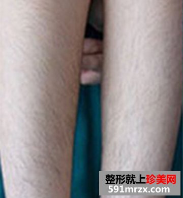 北京冰点脱毛医院,蓝宝石冰点脱毛
